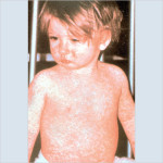 2-22-15 Child with measles rash