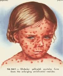 Smallpox and other biological agents